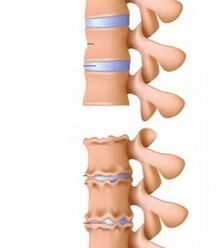 Kaela osteokondroosi kaldteed