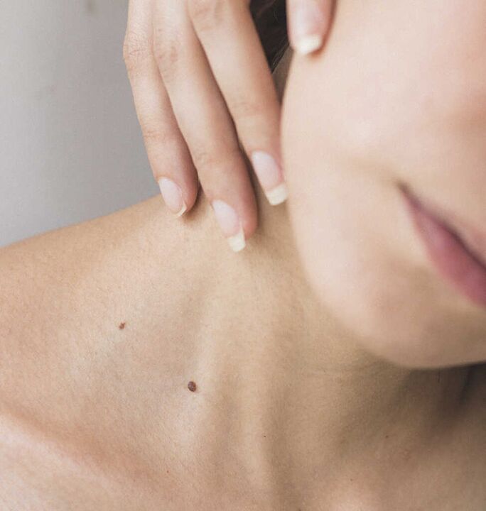 Kaela jäikus on üks emakakaela lülisamba osteokondroosi esialgse staadiumi sümptomeid.