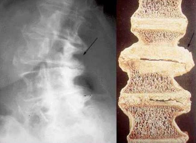 rindkere osteokondroosi selgroolülide kahjustus