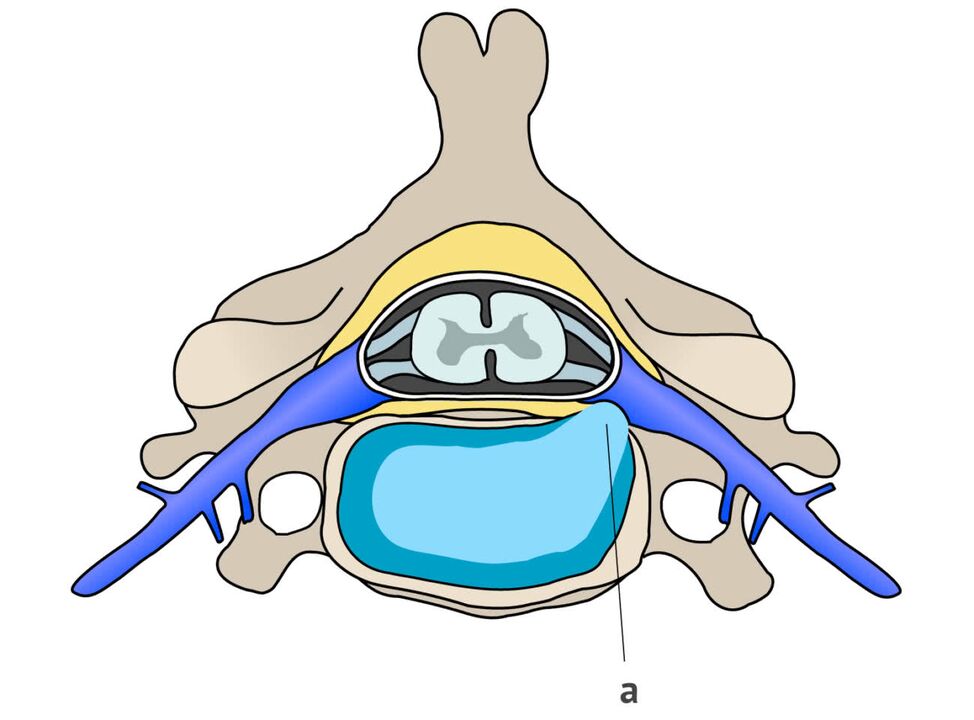 intervertebraalne song koos emakakaela osteokondroosiga